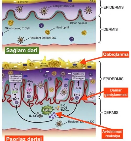 psoriazın yaranma səbəbi