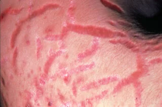 psoriaz xəstəliyinin müalicəsi kortikosteroid ilə