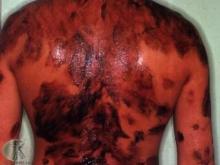 psoriaz xəstəliyinin müalicəsi qətran ilə