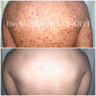 Bədəndə qırmızı səpgilər